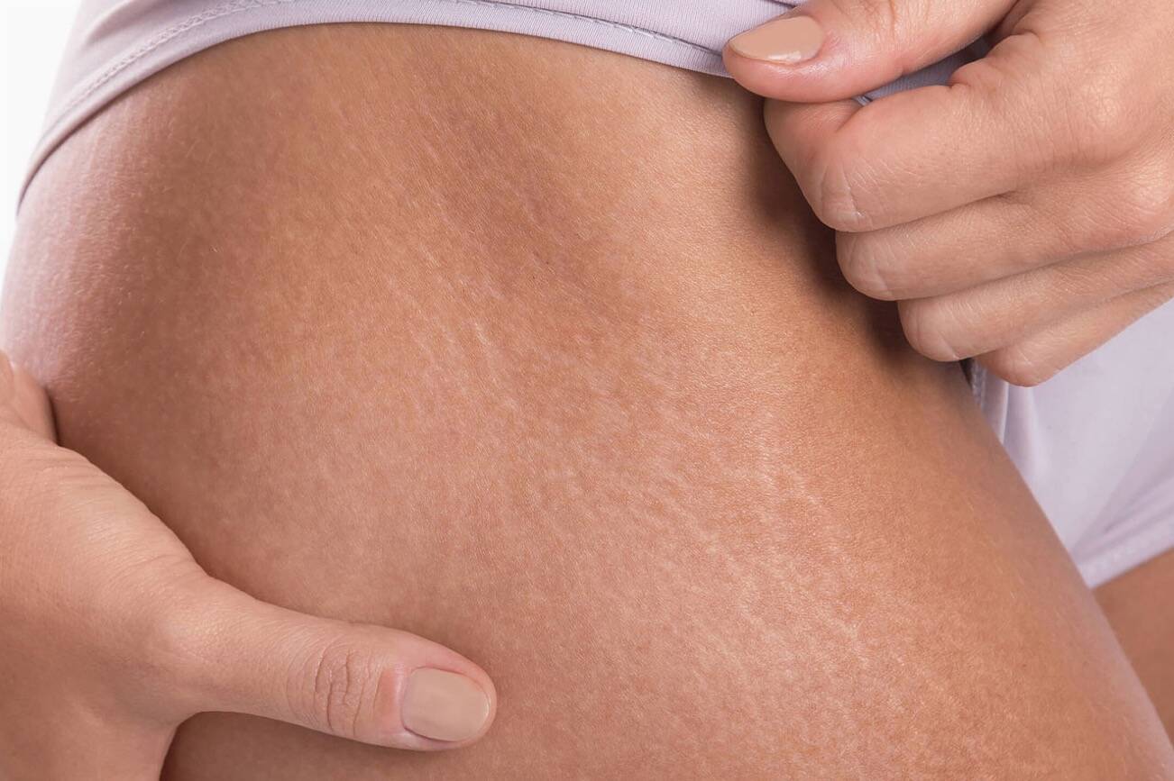 Best Stretch Mark Creams: Top Product Picks for Stretch Marks | HeraldNet.com