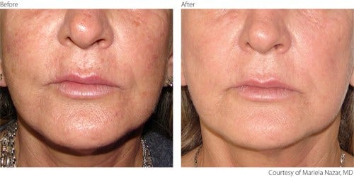Is Photorejuvenation Good for Skin? | by Mirajhammam | Jan, 2025 | Medium