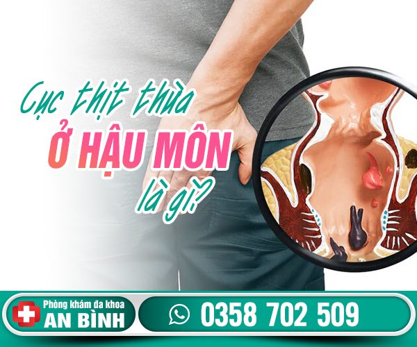 Cục thịt thừa ở hậu môn có nguy hiểm không?