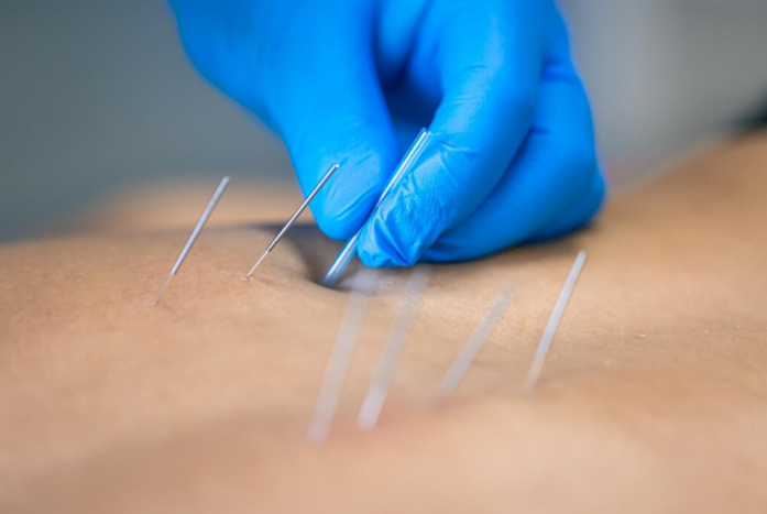 How Acupuncture for Weight Loss Works: Benefits, Results & Tips