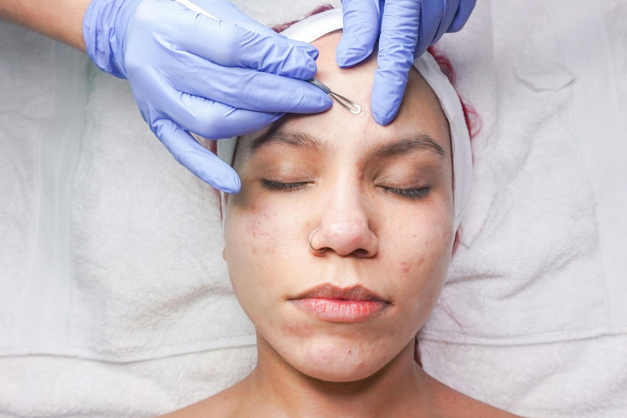 Pimple Marks Treatment Price Malaysia - Clear Skin Starts Here