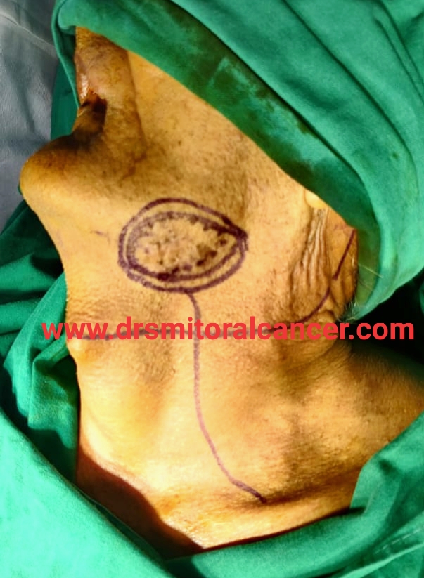 Leading Oral Cancer Surgeon in Ahmedabad | Dr Smit Desai